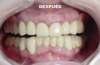 Clínica Dental José J. Pinilla Melguizo Tratamiento 4- 2