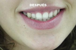 Clínica Dental José J. Pinilla Melguizo tratamiento 3-2