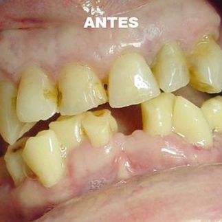 Clínica Dental José J. Pinilla Melguizo tratamiento 4-1