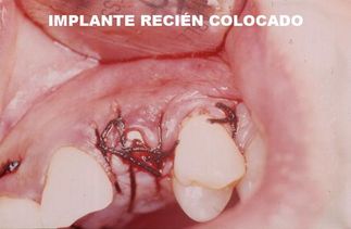 Clínica Dental José J. Pinilla Melguizo trtamiento 6-1
