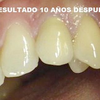 Clínica Dental José J. Pinilla Melguizo tratamiento 6-2