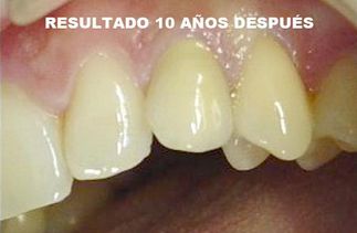 Clínica Dental José J. Pinilla Melguizo tratamiento 6-2